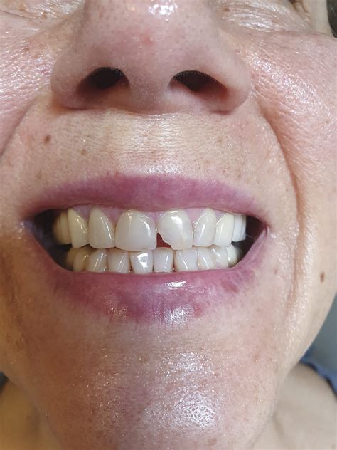 Image result for Broken Tooth Smile