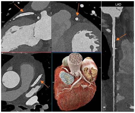 Image result for High Resolution CT Scan