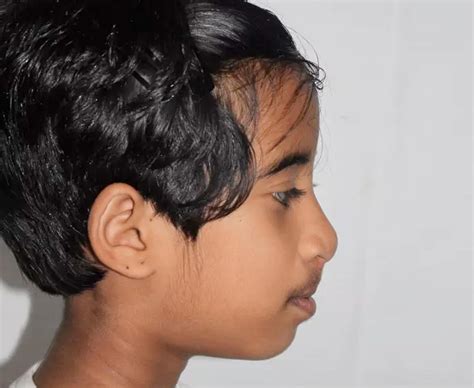 Image result for Maxillary Protraction