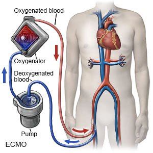 Image result for ECMO Patient