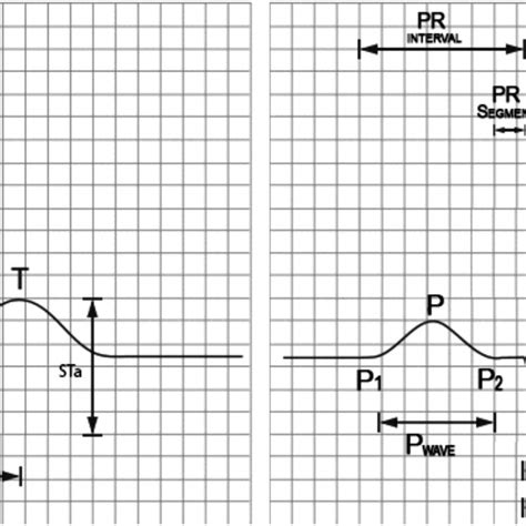 Hand Based ECG Signal に対する画像結果