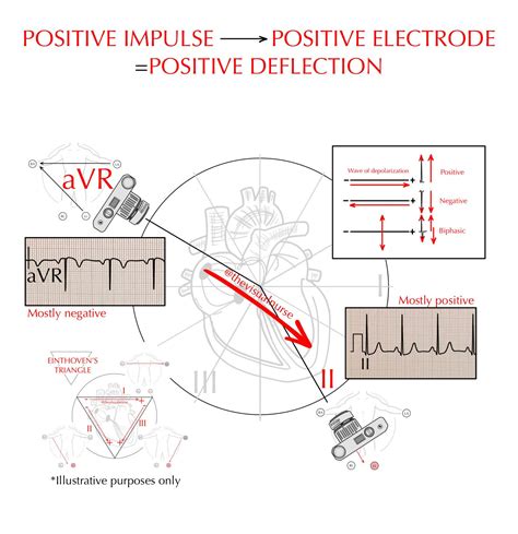 Image result for Negative Wave Deflection ECG