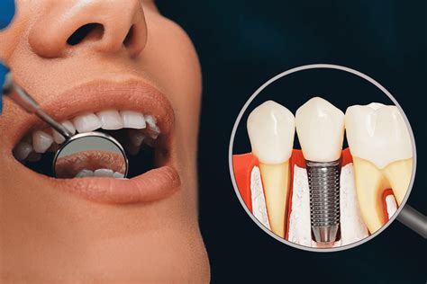 Image result for Tooth Implant Procedure