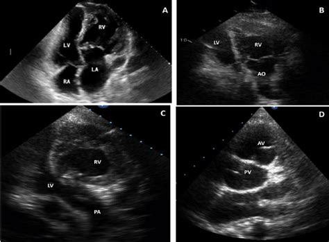 Afbeeldingsresultaten voor Corrected Transposition