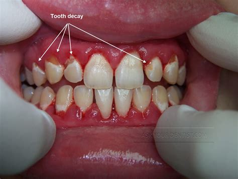 Image result for Broken Decayed Tooth