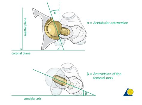 Toradh íomhá ar Femoral Anteversion vs Retroversion