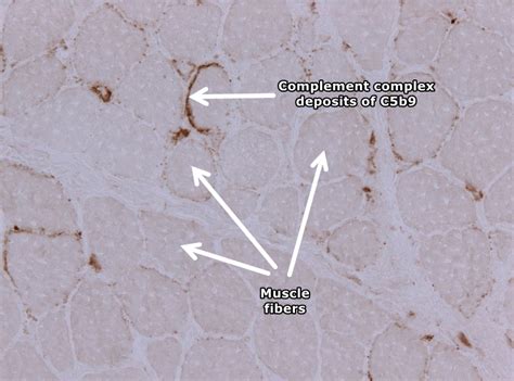 Image result for Dermatomyositis C3 Complement
