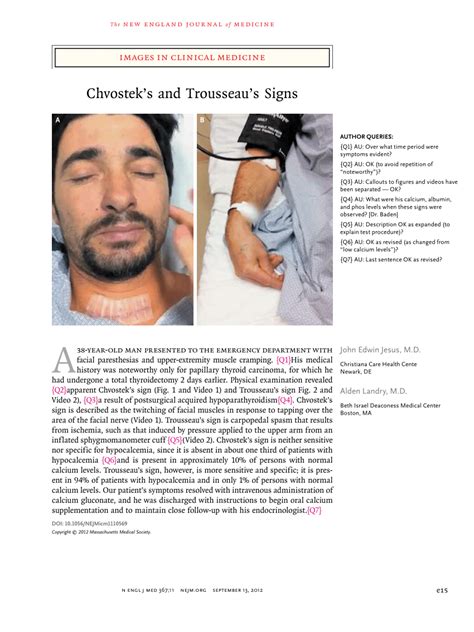 Image result for What Is Chvostek Sign