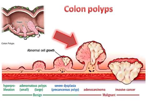 Image result for Polyp Nervous System