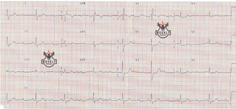 Image result for Normal PR Interval ECG