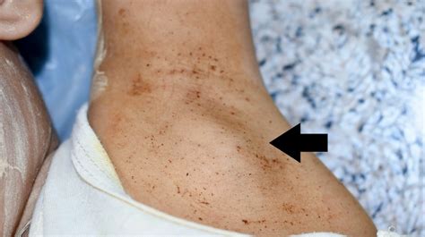 Image result for Painful Pimple Under Armpit