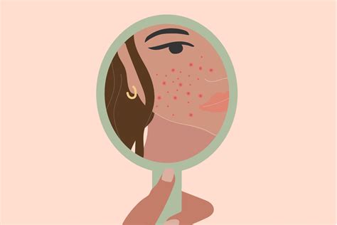 Inside Nodule Acne に対する画像結果