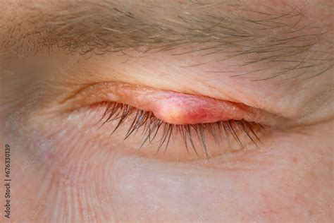 Image result for 2 Cm Cyst On Eyelid