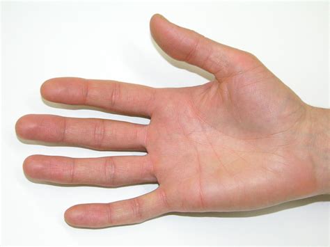 Image result for Hand Edema Coban Wrap