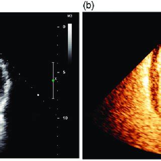 Image result for Echo Ultrasound Contrast