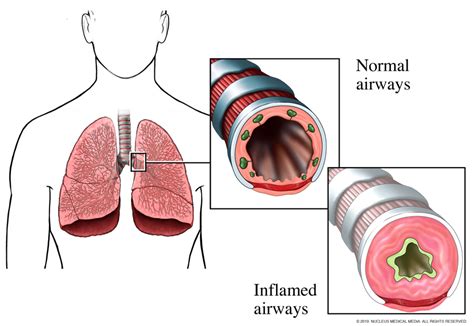 Image result for What Happens during an Asthma Attack