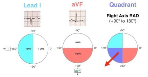 Image result for Positive and Negative Deflection ECG