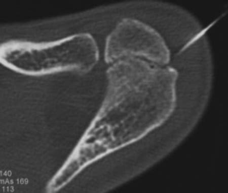 Image result for OS Acromiale Type 2