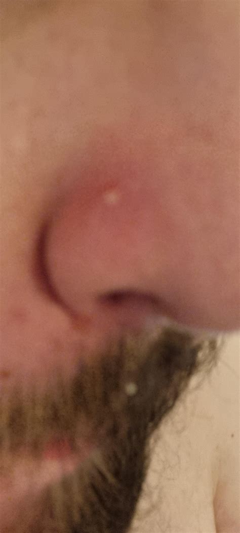 Exploding Pimple Pops に対する画像結果