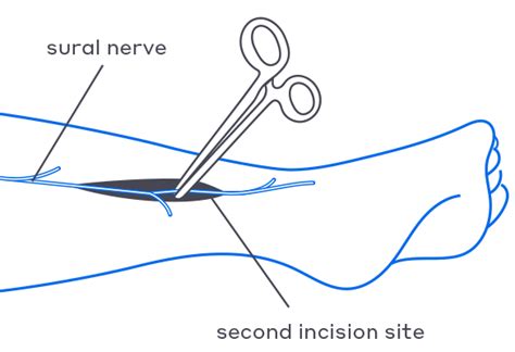 Image result for Nerve Cut