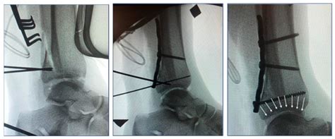 Ankle Posterolateral Approach に対する画像結果