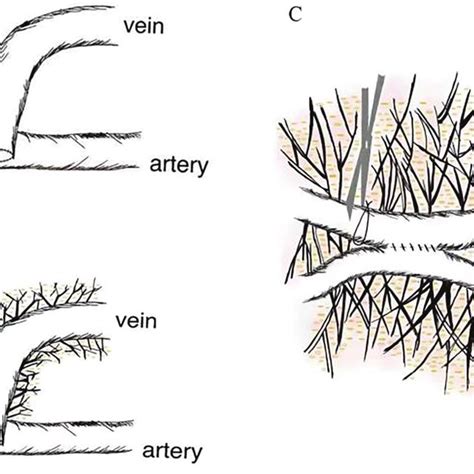 Image result for AVF Formation
