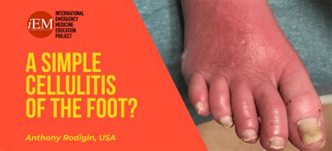 Résultat d’images pour Cellulitis On Foot and Ankle