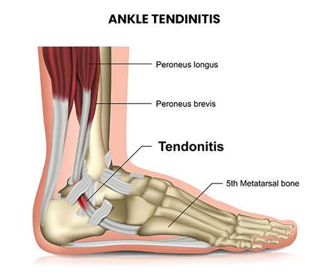 Image result for Tendon Ankle