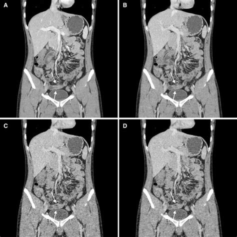 Image result for CT Enterography