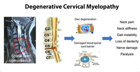 Cervical Myelopathy Digestive System に対する画像結果