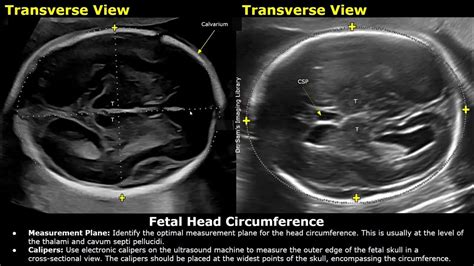 Toradh íomhá ar Abnormal Head Circumference