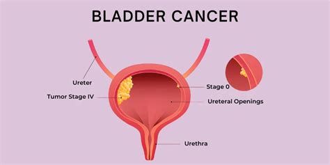 Image result for Bladder Cancer Life Expectancy