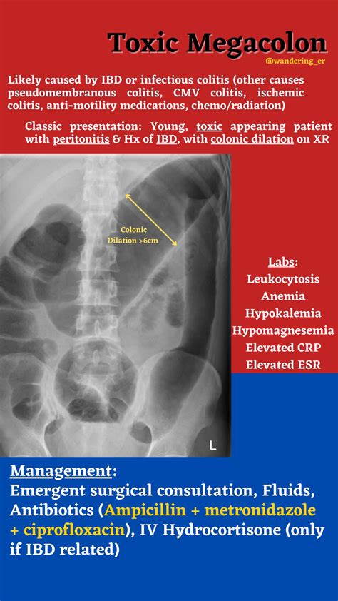 Image result for Megacolon
