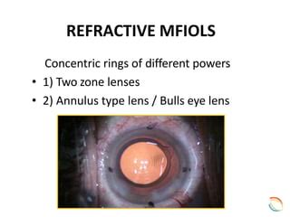 Image result for Refractive IOL Multifocal Optics