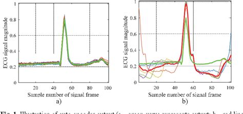 Hand Based ECG Signal に対する画像結果