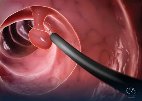 Image result for Colonoscopy Mins