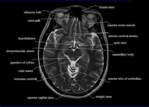 Image result for Normal Brain MRI Axial Labelled