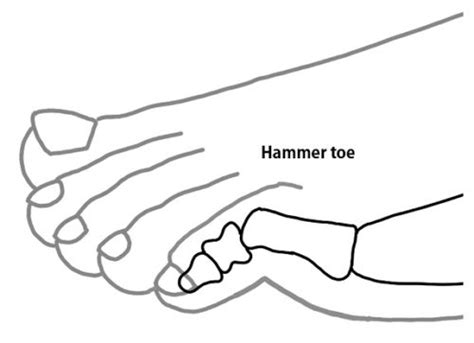 Image result for Hammer Toe Problems