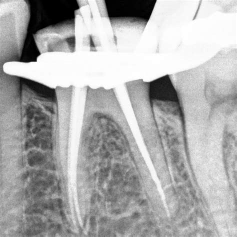 Afbeeldingsresultaten voor RVG Sensor Layer