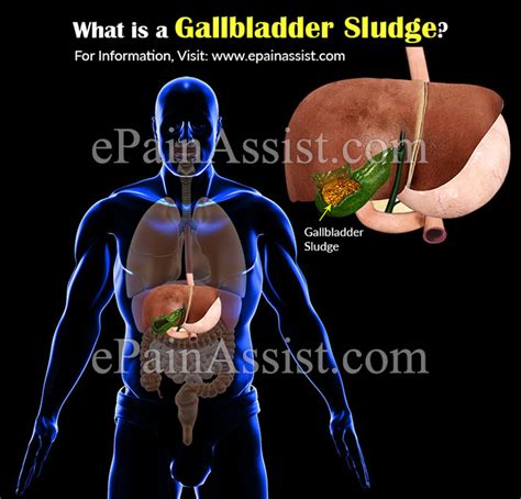 Image result for Sludge in My Gallbladder