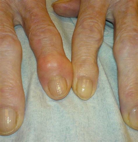 Image result for How to Get Rid of Hererdens Nodes