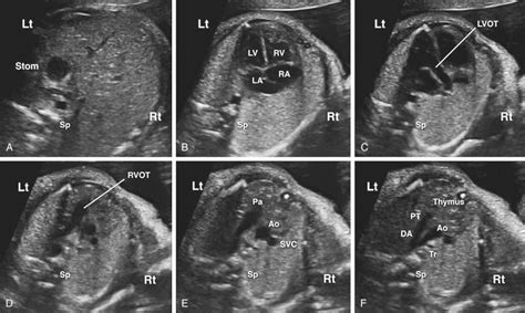 Fetal Heart Spatial Transcriptomics に対する画像結果