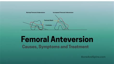 Toradh íomhá ar Femoral Anteversion vs Retroversion