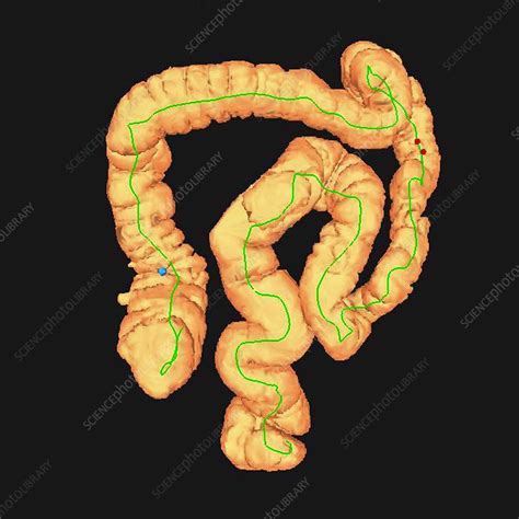 Image result for Virtual Colonoscopy Procedure