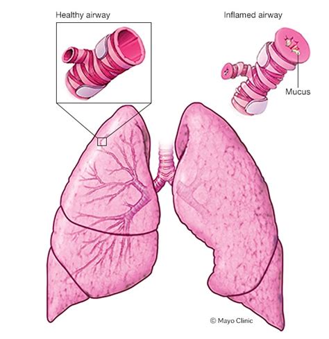 Image result for What Happens during an Asthma Attack