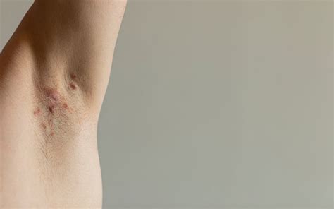 Image result for Painful Pimple Under Armpit