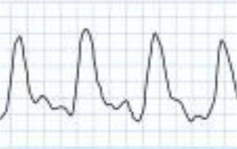 Pressure Gradient Segmental Pressure Lower Extremity に対する画像結果