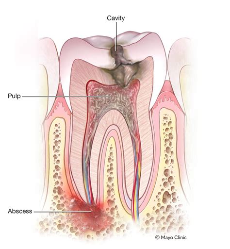 Afbeeldingsresultaten voor Molar Abscess
