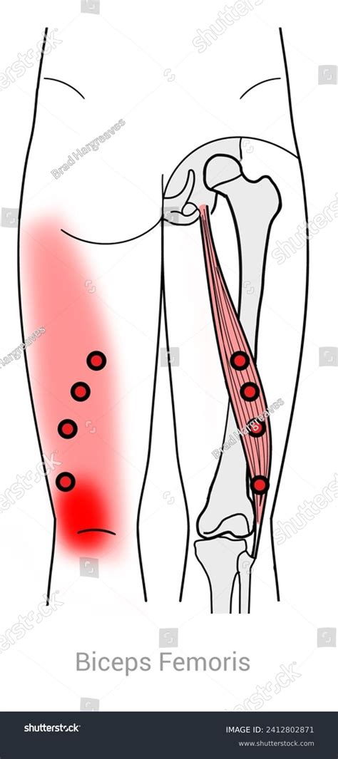 Hamstring Attachment and Trigger Point に対する画像結果