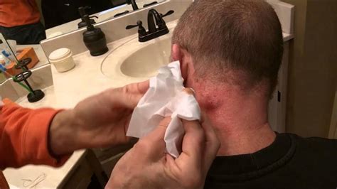 Image result for Sebaceous Cyst Pimple